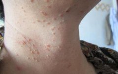 扁平疣是什么原因长出来的如何治疗